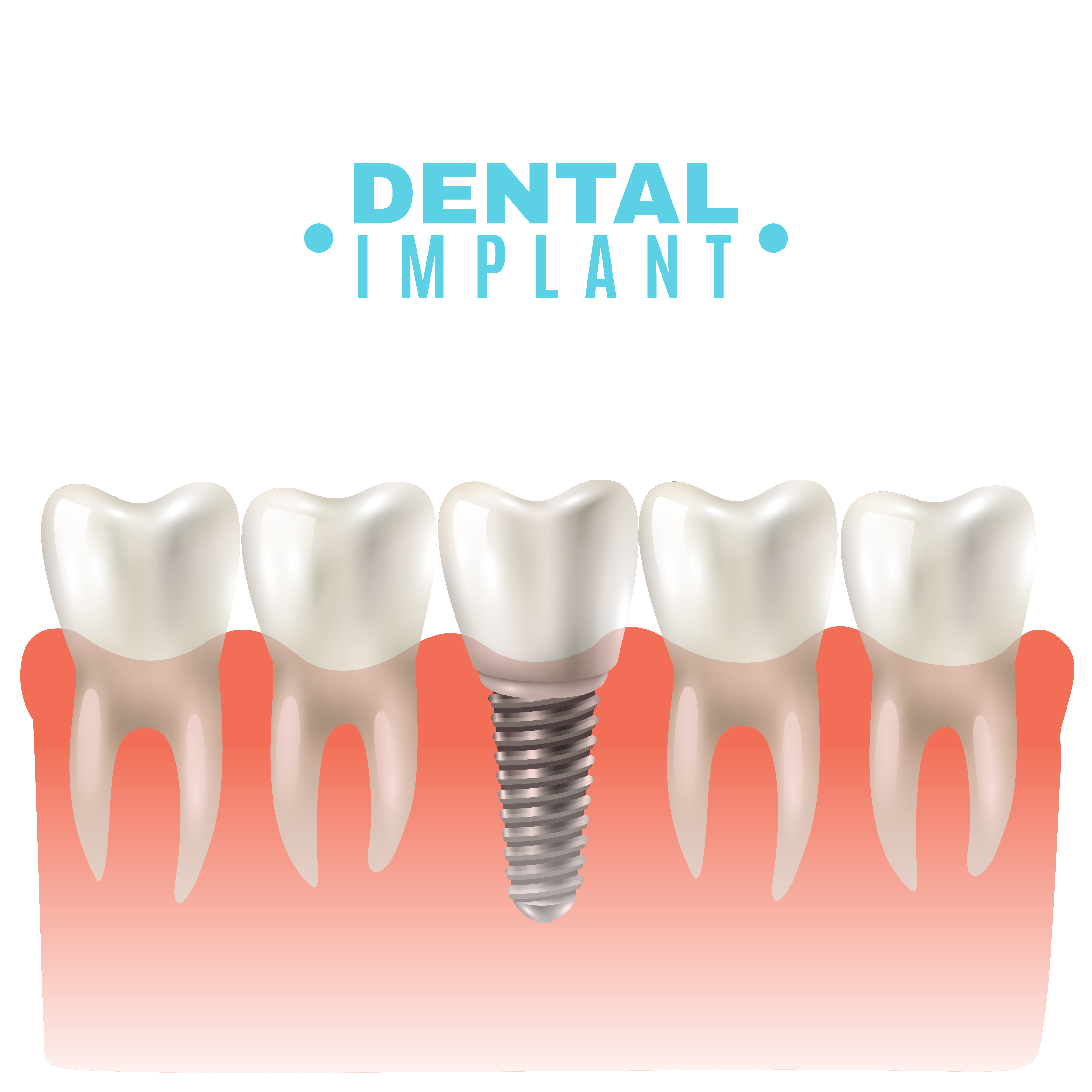 Dental implant illustration